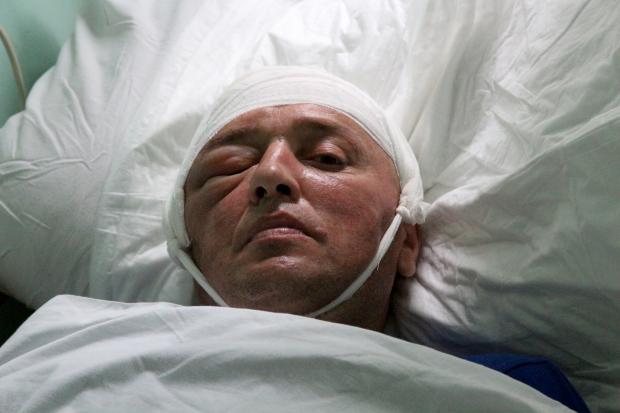 Медики вживили у голову пораненого Руслана Зварича із Яворівки металеву пластину розміром 15х15 сантиметрів | Фото: Тара