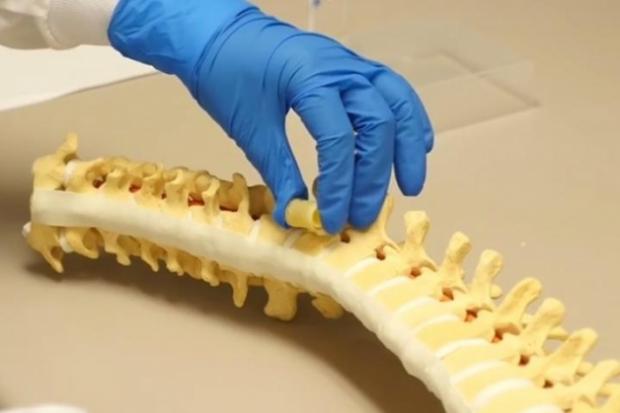Вчені створили губчастий імплантат, який вбирає рідину з організму і розширюється, заповнюючи вільне місце між здоровими
