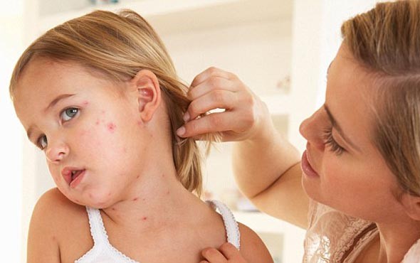 Єдиним шляхом профілактики кору та запобіганню ускладнень від нього  є щеплення