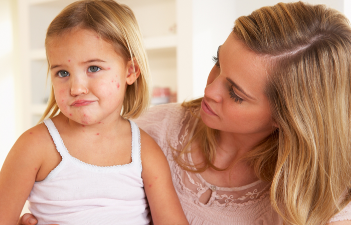 Специфічного лікування проти кору не існує, щащанчають медики. Проте, хворобі можна запобігти &mdash; вакцинацією