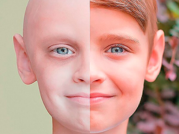 Ілюстрація. Найбільше дітей з онкогематологічними захворюваннями та хворих на рак в Івано-Франківську, Надвірнянському т