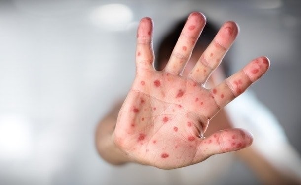 Ілюстрація. Внаслідок ускладнень від кору померли дві дитини