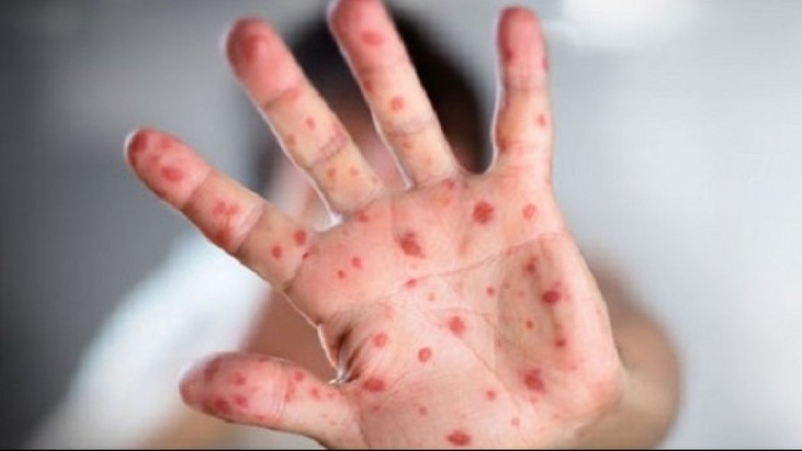 Нещодавно у Калуші з діагнозом "кір" було зареєстровано 17 пацієнтів: троє дорослих,  решта - діти