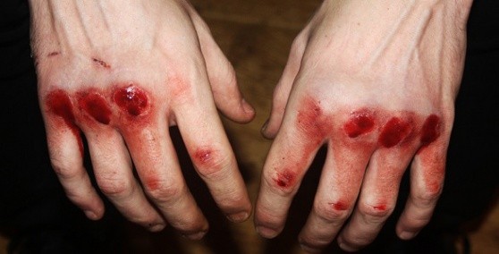 Ілюстрація. На Прикарпатті під час застілля побилися брати &ndash; в одного проламаний череп
