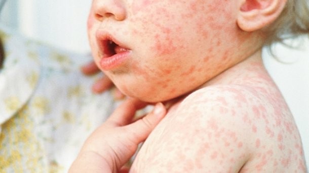 Ілюстрація. Усього на Калущині було госпіталізовано 159 осіб, із яких 120 &mdash; діти