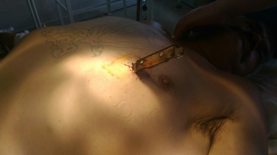 Хірург розповів, як нещодавно провів не легку операцію та витянув ніж з грудей пацієнта