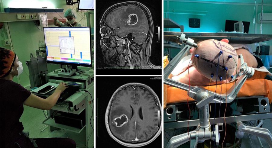 Операції надзвичайно складні, позаяк пухлини були розташовані у функціональних зонах мозку хворих