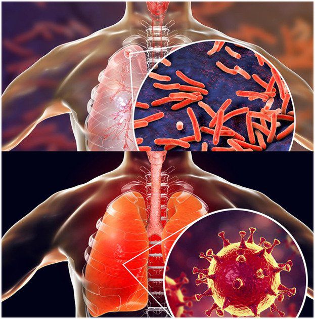Ілюстрація. Якщо ви помітили в себе симптоми туберкульозу, варто звернутись до лікаря