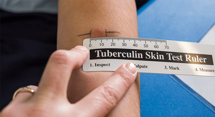 Пробу Манту варто обов’язково проводити для дорослих і дітей, які мають певні чинники ризику розвитку туберкульозу