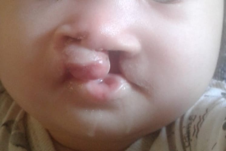 Ангелінка вже перенесла чотири операції. Ще на дві потірбно зібрати 30 тис. гривень