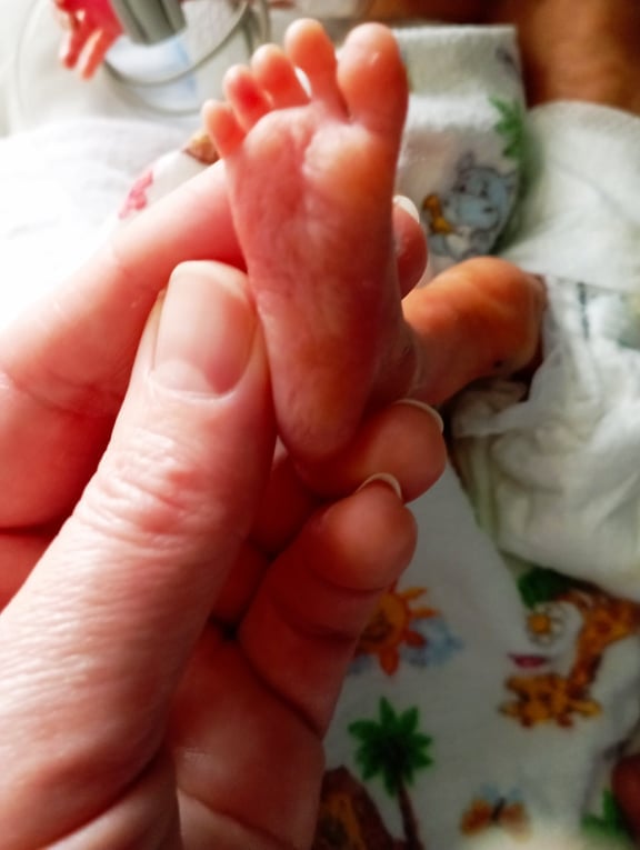 Завдяки зібраним коштам вдалося закупити 5 інфузійних насосів, які вже допомагають одужати маленьким пацієнтам