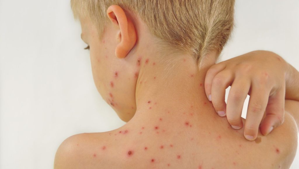 Ілюстроване фото. Максимальна кількість тих, хто інфікується, припадає на вікову групу 2-4 роки