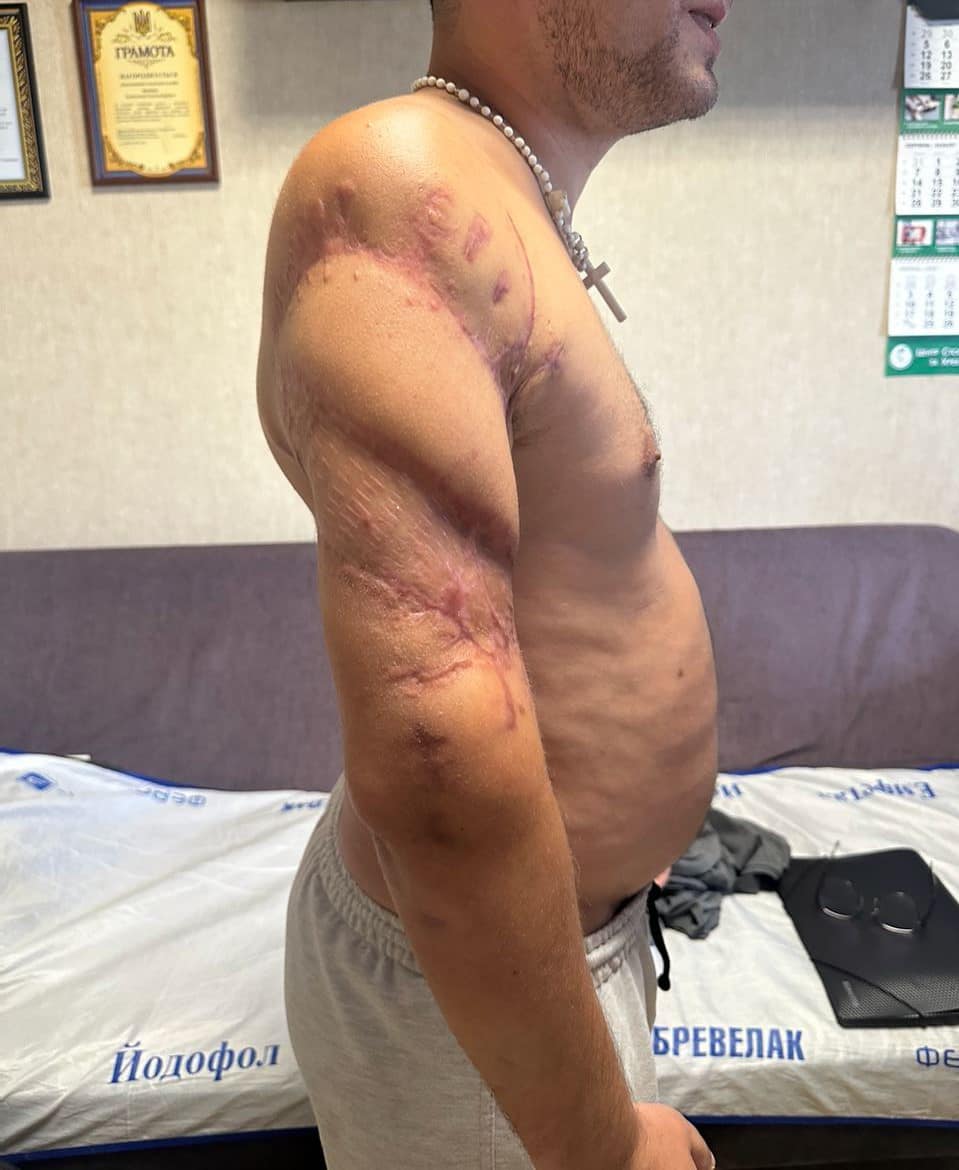 Для протезування кісток використовують індивідуальні титанові імпланти, виготовлені за допомогою 3D-технологій