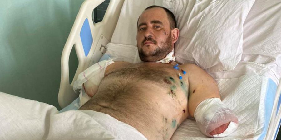 Боєць втратив руки під час унікальної операції.