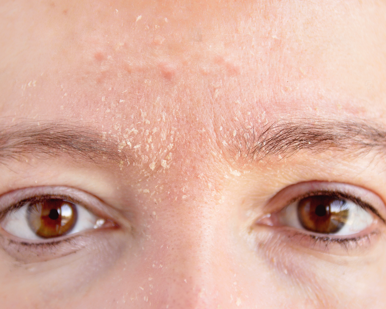 Ілюстроване фото.     Лікування зазвичай проводиться комплексне. Спочатку треба звернутися до дерматолога.