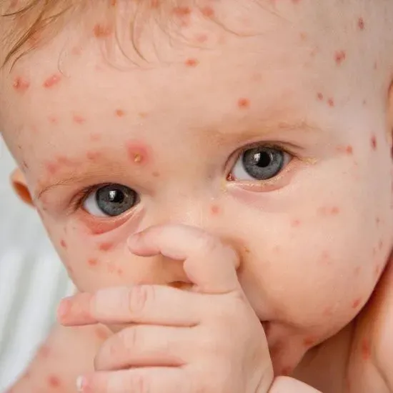 Ілюстроване фото. Батьків застерігають: кір може викликати: пневмонію, запалення вуха, ураження мозку