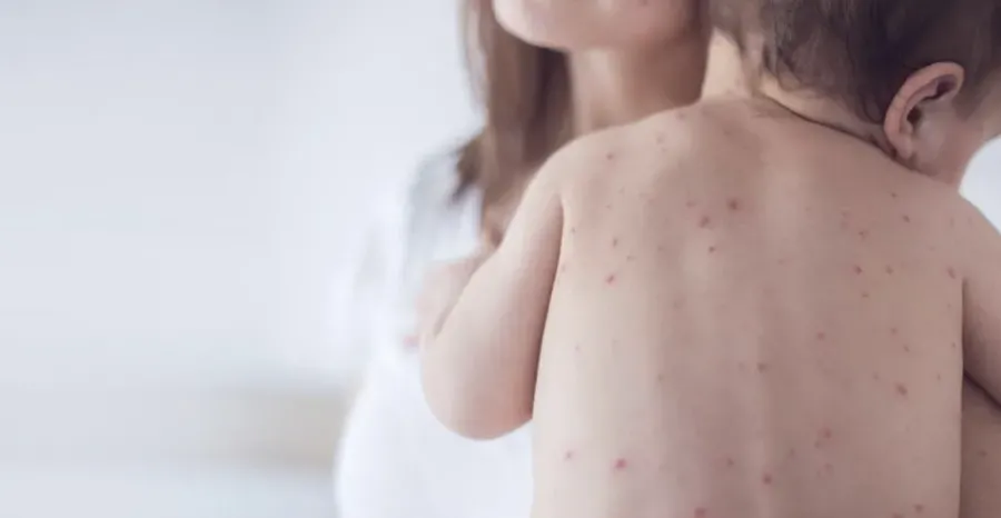 Ілюстроване фото. Поширення захворювання на кір у Калуському районі набирає обертів