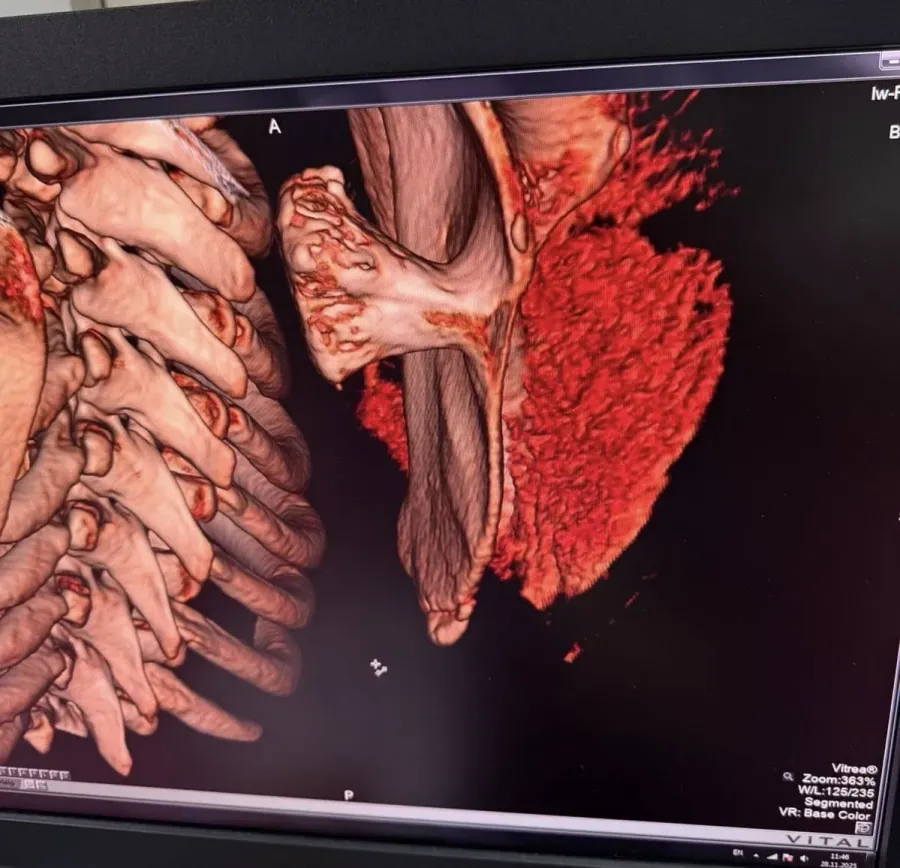 На консиліумі лікарів ухвалено рішення про проведення оперативного втручання