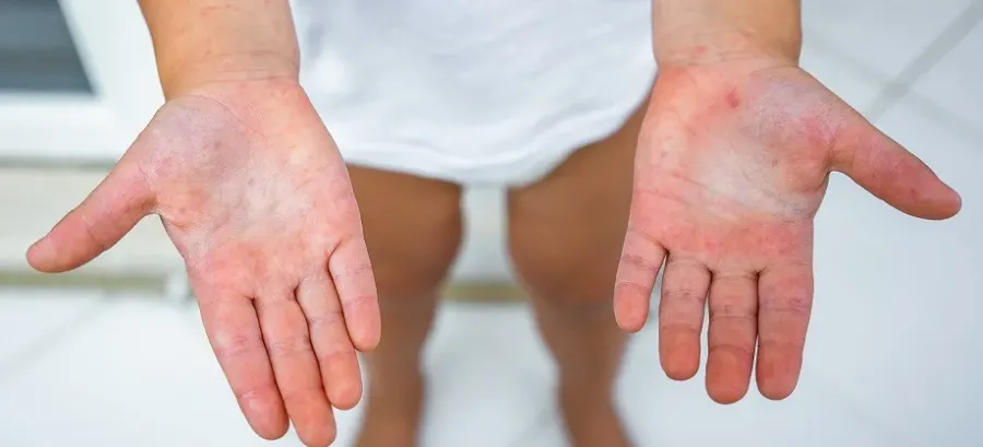 Ілюстроване фото. Скарлатину діагностували в 60 мешканців міста та 10 мешканців сільської місцевості